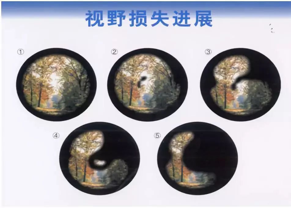 突然视野缺损后自动恢复是什么原因