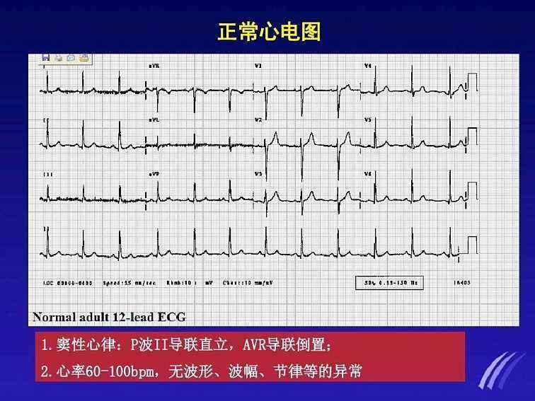 正常的心电图是什么样的图形