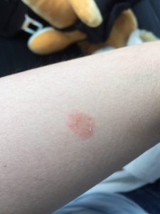 系统性红斑狼疮图片（系统性红斑狼疮图片皮肤）